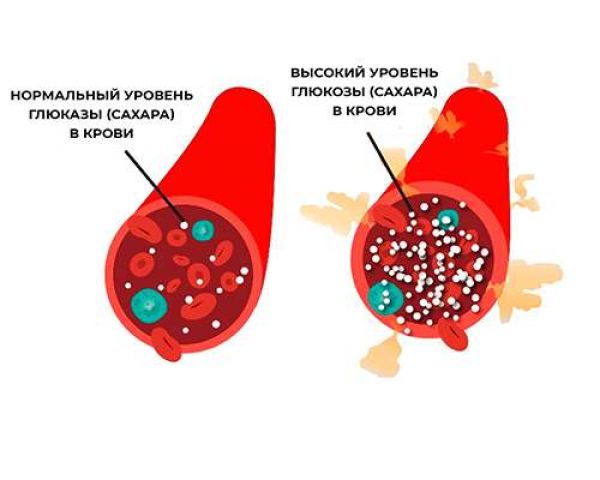 Сахарный диабет – симптомы и лечение