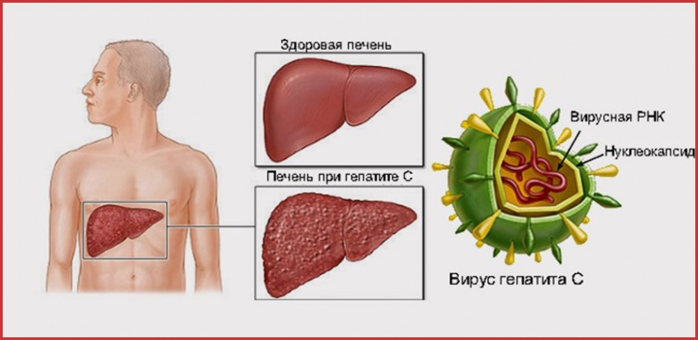 Неделя по борьбе с заражением и распространением хронического вирусного гепатита С