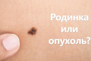 Что нужно знать о меланоме?